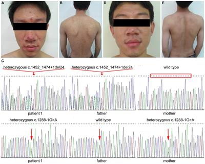 Variants of SLC39A4 cause acrodermatitis enteropathica in Tibetan, Yi, and Han families in Sichuan region of southwestern China: a case report series